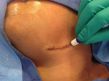 Replacing Stitches with Super Glue By: John McCann, MD, PhD
